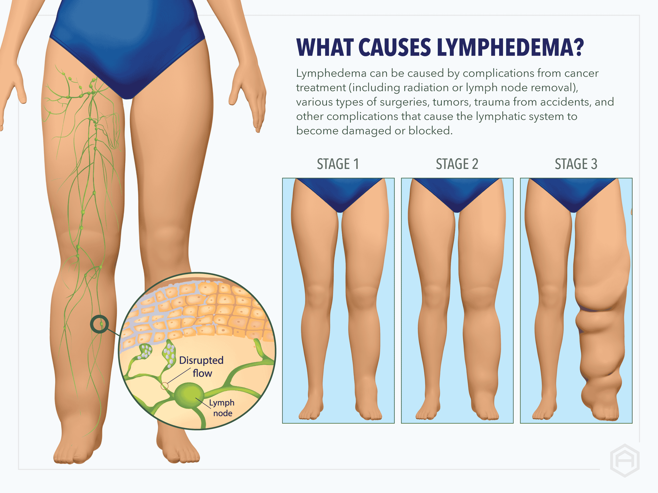 Compression for breast oedema - Lymphoedema Education Solutions