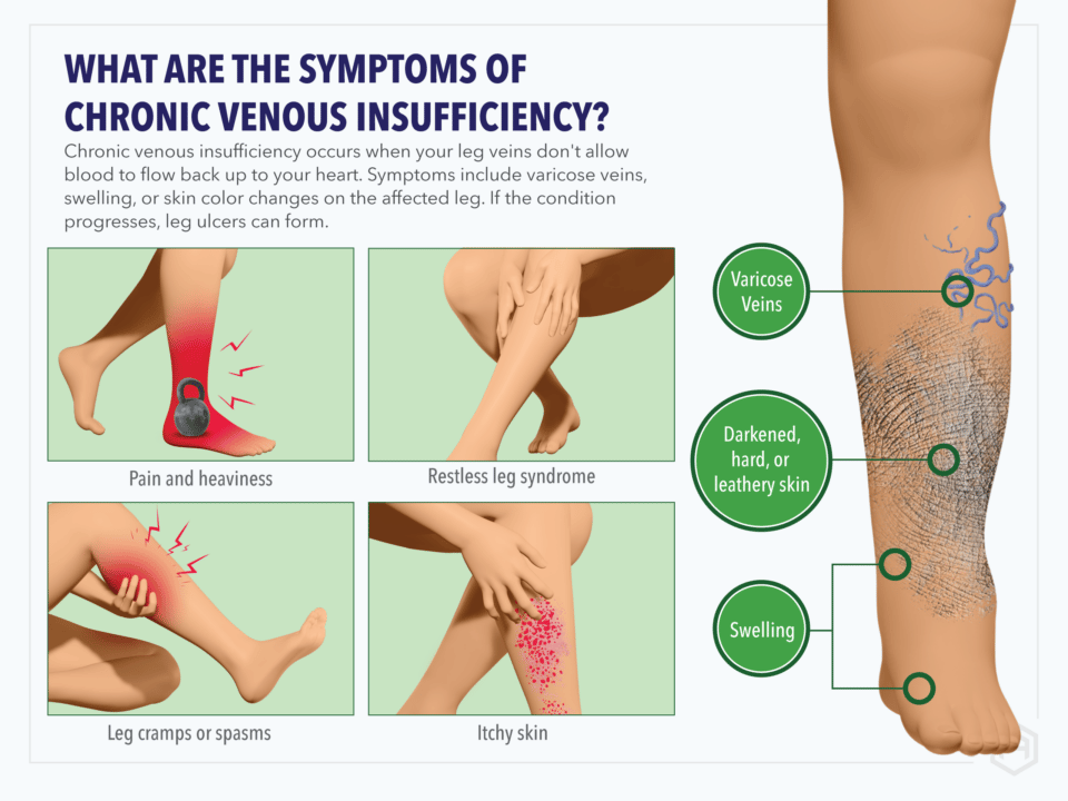 Venous Insufficiency | Venous Ulcers | Pneumatic Compression | AIROS