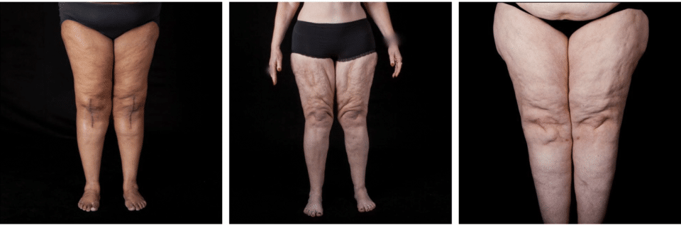 Lipedema Airos Medical Inc 4535